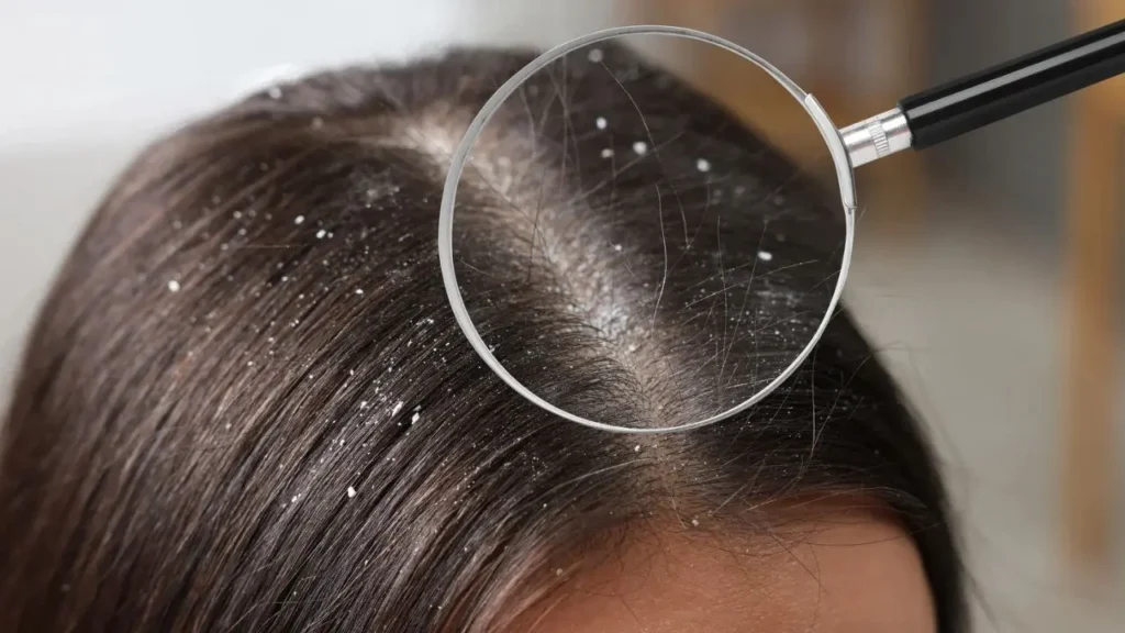 खोपड़ी पर Dandruf (रूसी) के सफेद फ्लेक्स; आवर्धक कांच से स्कैल्प का क्लोज-अप दिखाई दे रहा है।