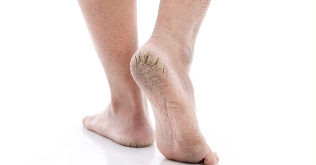 फटी एड़ियों से परेशान? अपनाएं ये 7 घरेलू नुस्खे