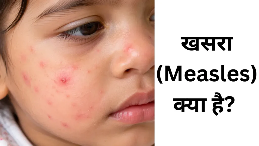 खसरा के लक्षण: चेहरे पर लाल चकत्ते और त्वचा पर दाने